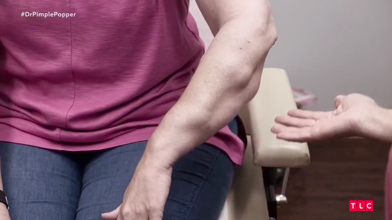 Illustration for article titled Dr. Pimple Popper Removes 68 Lipomas from One Person in Season 2 Premiere
